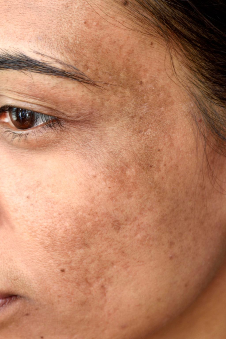 Hydroquinone