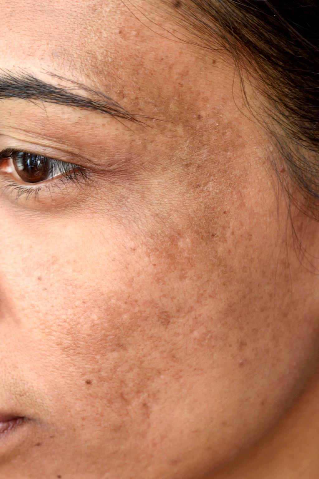 Hydroquinone